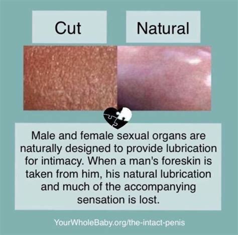 Circumcision cuts the foreskin and without it, the glans can receive excessive rubbing causing discomfort or pain. . Glans keratinization treatment